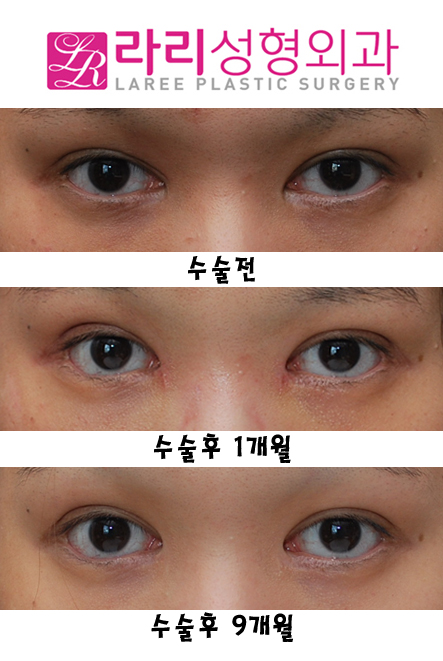 앞트임복원 후 모양변화 관련 이미지 1