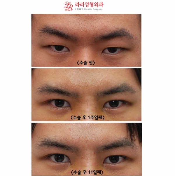 Natural-looking non-incisional eye correction surgery for men with single eyelids is the trend! image 4