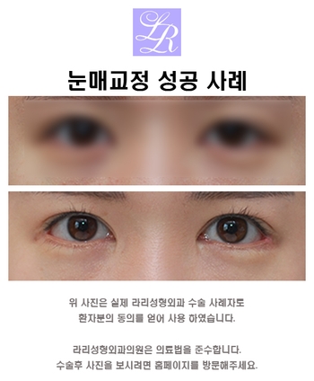 Small Eyes Surgery That Makeup Can’t Fix - Big-Eye Surgery image 7