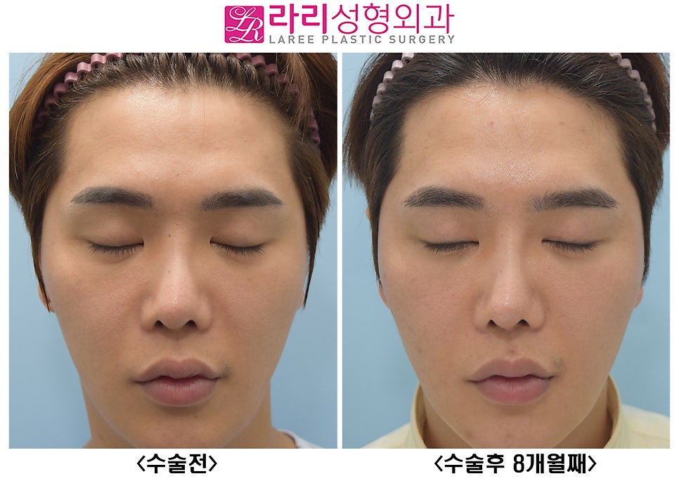 [라리성형외과] 여러겹 두꺼운 자연 쌍꺼풀 무쌍으로 풀기, 없애는 수술 관련 이미지 6