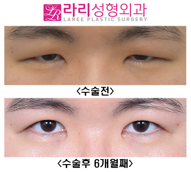 [Lari Plastic Surgery] The Effect of Double Eyelid Incision Ptosis Correction That Opens Unopened Eyes Wide image 1