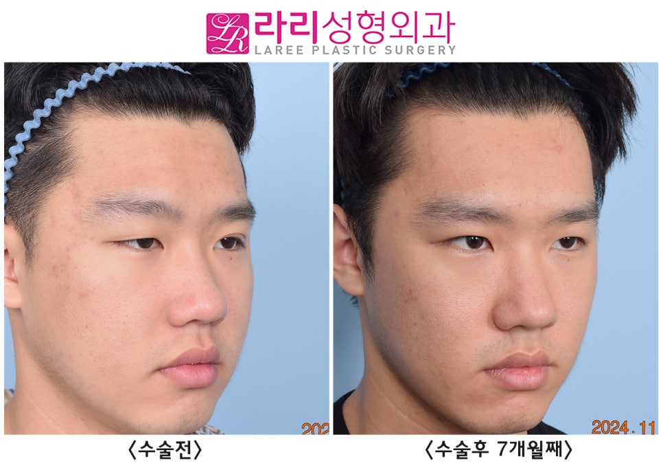 [라리성형외과] 쌍꺼풀 없애는 수술로 쌍꺼풀 없애기, 그 후 달라지는 얼굴 전체의 인상 관련 이미지 2