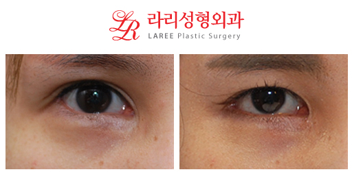 Restoration of Epicanthoplasty and Removal of Sunken Double Eyelid Scars image 3