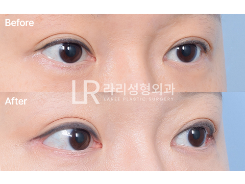 [라리성형외과] 뒤트임재수술 티 나게 잘하는 병원 라리성형외과 관련 이미지 4