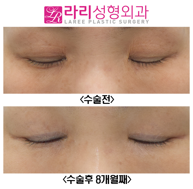 [라리성형외과] 여자도 하는 쌍꺼풀없애는수술, 앞트임수술과 찰떡 관련 이미지 4