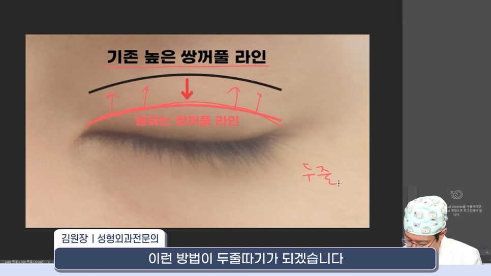 [라리성형외과] 쌍꺼풀재수술 라인 낮추는 두 가지 수술법 (절제방법 , 두줄따기방법) 관련 이미지 2