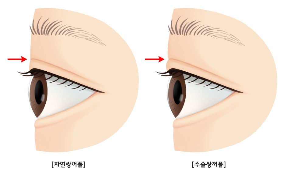 [Lari Plastic Surgery] One-sided double eyelid surgery to correct uneven eyes: Is it possible to get double eyelids on only one eye? image 1