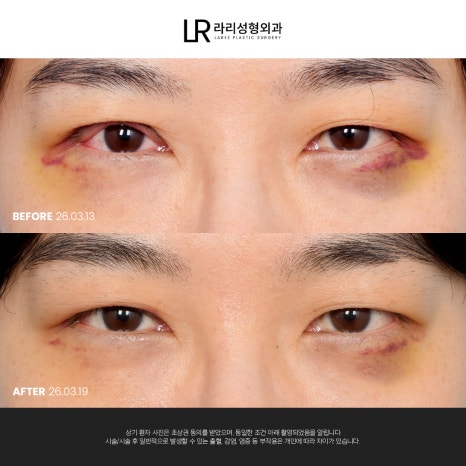 [라리성형외과] 눈 (재) 수술은 라리성형외과가 관련 이미지 5
