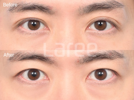 [Lari Plastic Surgery] Everything About Double Eyelid Removal Surgery image 6