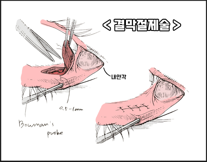 [라리성형외과] 안검외반교정의 성형외과 교과서적 수술법 관련 이미지 1