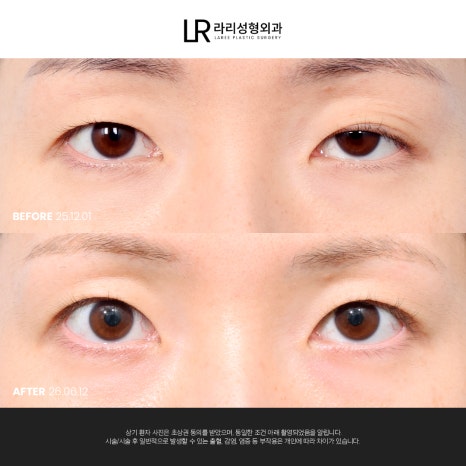[라리성형외과] 눈 (재) 수술은 라리성형외과가 관련 이미지 10