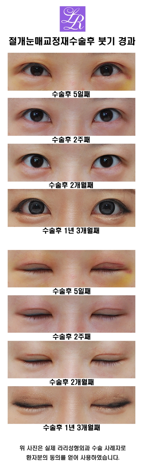 When Reoperation Is Needed for Ptosis Correction Surgery, and the Timing of Surgery (feat. Rapid Correction) image 4