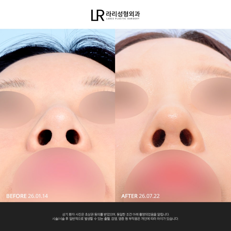 [LARI Plastic Surgery] Structural Line Rhinoplasty Revision Connecting the Nasal Bridge, Dorsum, and Tip image 4