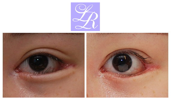 If You Want an S-Line Under Your Eyes, Try Lower Eye Widening image 5
