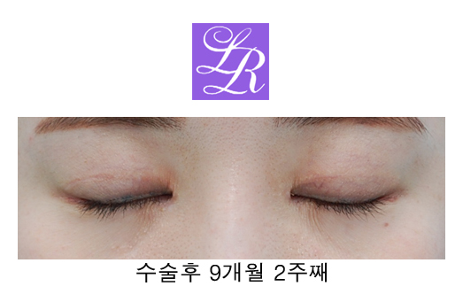 Changing Eyelid Crease Shape with Double Eyelid Reversal Surgery image 5