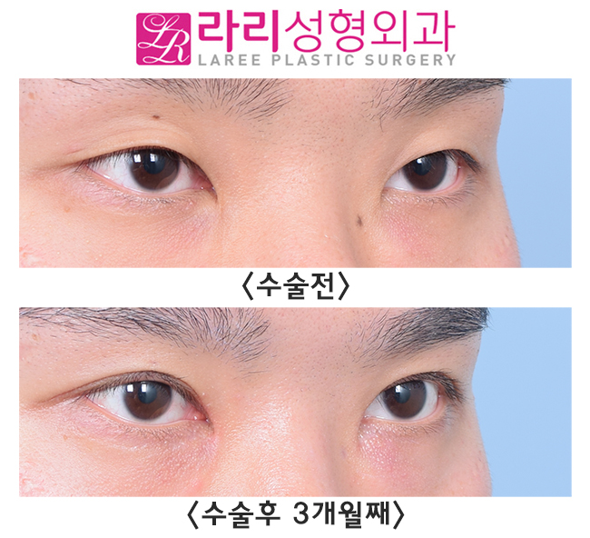[라리성형외과] 이 정도 속쌍라인 절개눈매교정 어떤가요? 관련 이미지 3