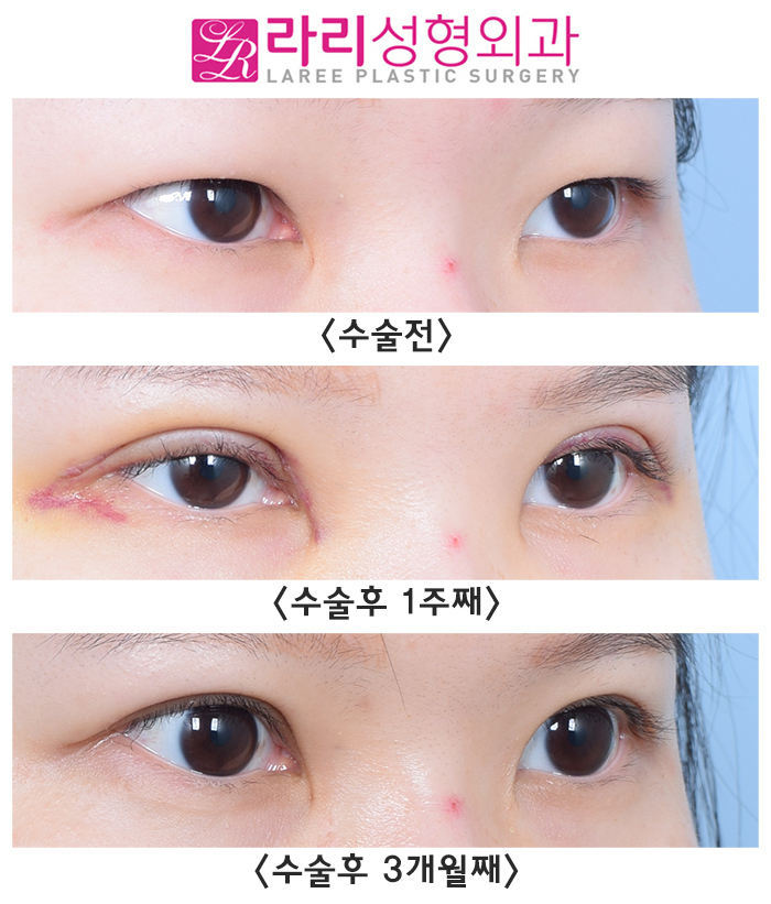 [Lari Plastic Surgery] The Recovery Process After Incisional Ptosis Correction: Don’t Be Surprised, Just Wait! image 1