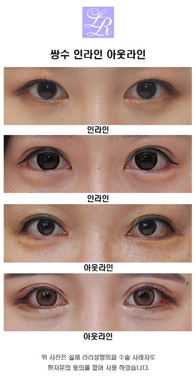 아웃라인 쌍수 높이에 대해 관련 이미지 2