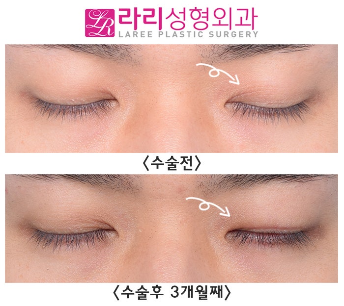[Lari Plastic Surgery] Removing a Double Eyelid That Formed on Only One Side - Left? Right? Either Is Fine image 4