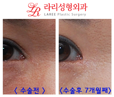 앞트임흉터제거 및 앞트임복원/앞트임재건의 효과를 알아보자! 관련 이미지 8