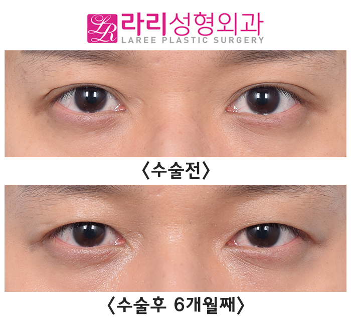[라리성형외과] 쌍꺼풀없애기수술은 쌍꺼풀을 없애주는 겁니다. 관련 이미지 1