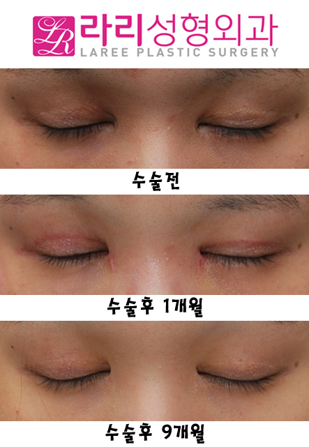 앞트임복원 후 모양변화 관련 이미지 2