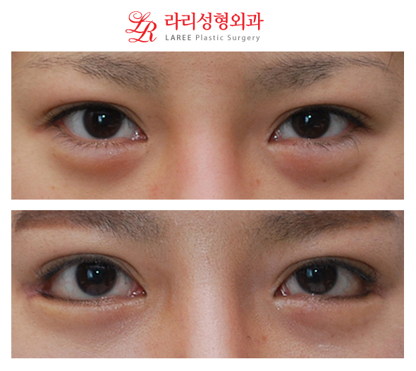 뒤트임/뒷트임 사진 후기 정보☆ 관련 이미지 2