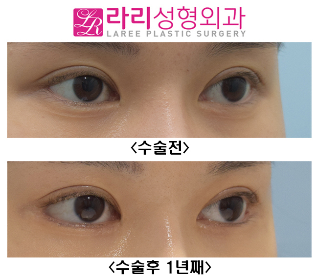 [라리성형외과] 뒤트임수술 첫 수술에 효과적으로 성공하기 관련 이미지 1
