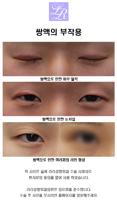 Double eyelid surgery with an inner crease as charming as an outer crease image 1