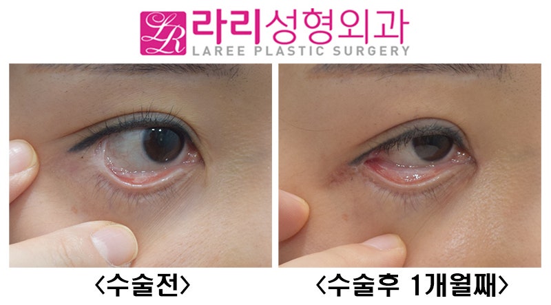 [라리성형외과] 뒤트임재수술,결막이식으로 뒤트임부작용(물갈퀴변형, web deformity) 교정하기 관련 이미지 6