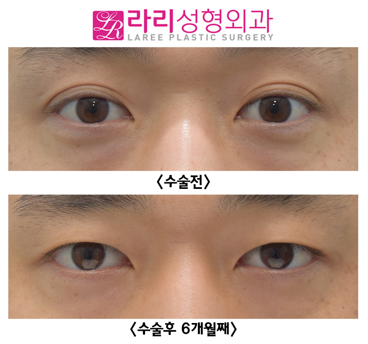 [라리성형외과] 두꺼운 자연 쌍꺼풀 완전 무쌍으로 만드는 쌍꺼풀제거수술 전후사진 관련 이미지 1