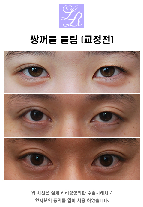 Double Eyelids, Especially When One Eye Has a Double Eyelid image 2