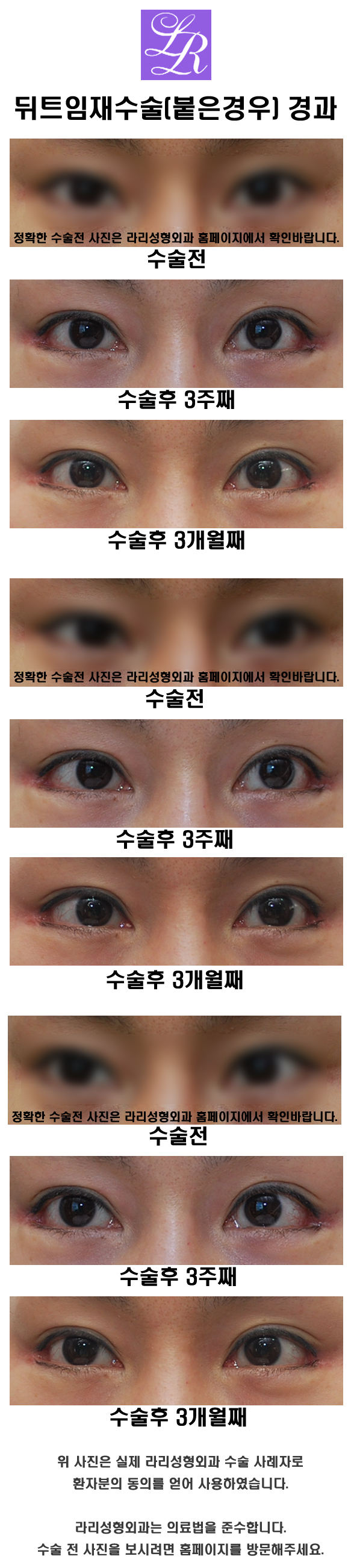 Where is the best place for revision canthoplasty? image 3