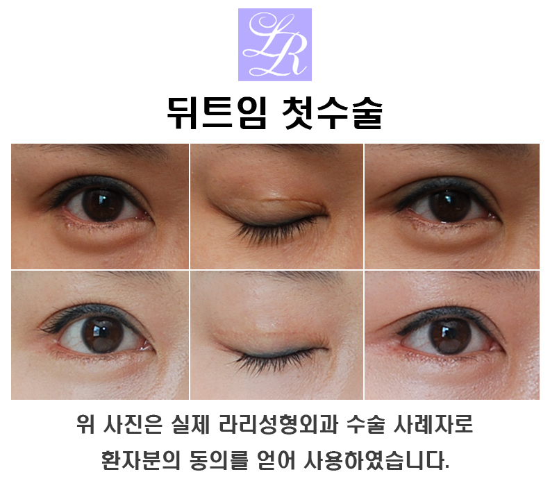 Lateral Canthoplasty Surgery - Recovery, Before and After, Good Results for the Eyes @Lari Plastic Surgery image 2