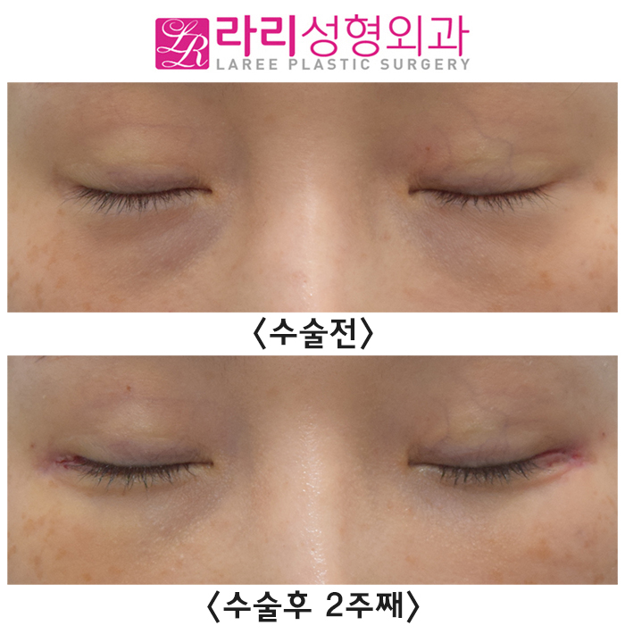 [라리성형외과] 뒤트임재수술 실밥 제거 당일 수술후 2주째 단기 경과 전후 사진 관련 이미지 4