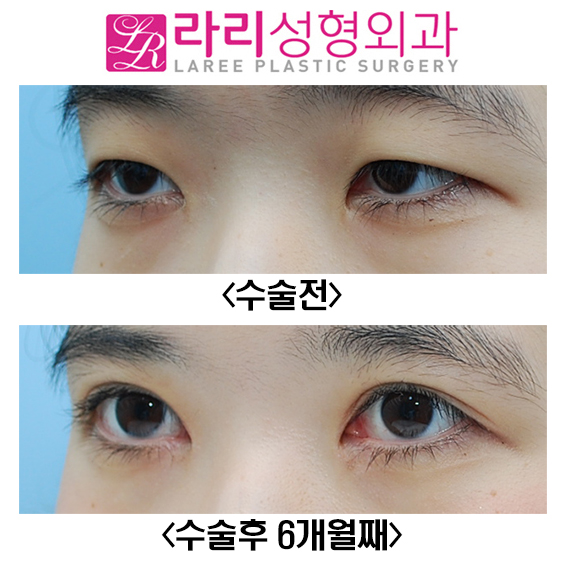 [Lari Plastic Surgery] Before-and-After Photos Showing Clear Results from Incisional Eye Correction and Epicanthoplasty image 3