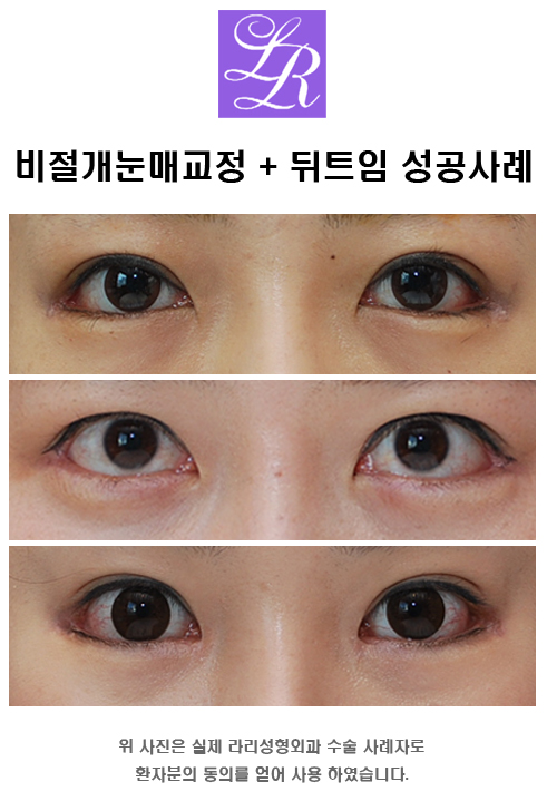 뒤트임 눈매교정 함께 관련 이미지 6