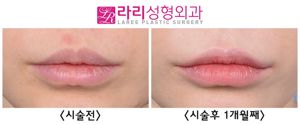 [라리성형외과] 1cc의 변화, 웃는 입모양 만드는 입꼬리 필러 전후 사진 관련 이미지 2