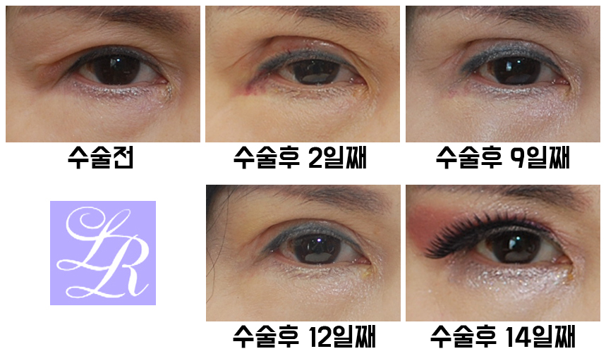 Revision Surgery to Raise the Buried Double Eyelid Line - Will It Change the Eye Shape? image 2