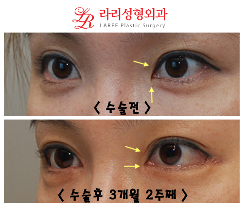 Before-and-After Photos of Epicanthoplasty / Canthoplasty image 3