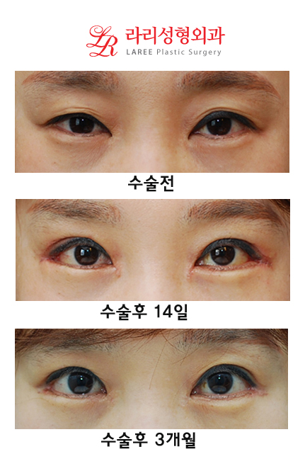 Revision Eyelid Surgery, Cases That Need Ptosis Correction, Correcting Asymmetry in Uneven Eyes image 7