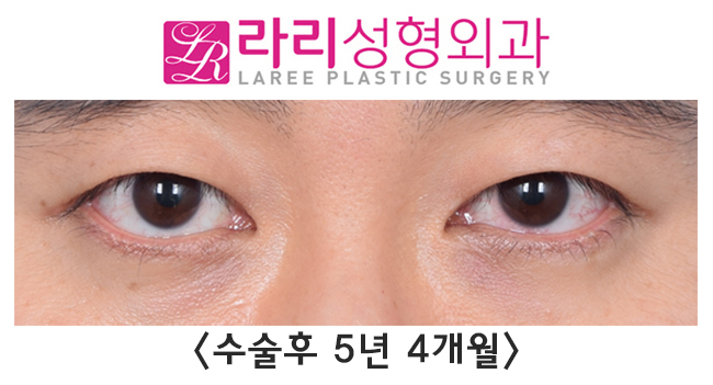 [라리성형외과] 쌍꺼풀없애는수술 단기 회복부터 장기 경과까지 관련 이미지 5