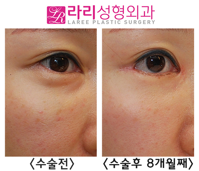 [Lali Plastic Surgery] Comparison Photos of the Before-and-After Differences of Epicanthoplasty Restoration, Revision Lateral Canthoplasty, and Fat Graft Removal Surgery (Under-Eye + Cheekbone Area) image 4
