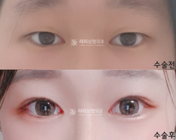 [라리성형외과] 쌍꺼풀수술 그리고 쌍꺼풀재수술 , 성공하려면 어디서 해야 할까요 !? 관련 이미지 1