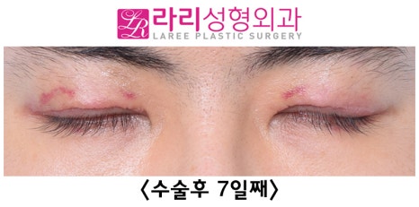 [라리성형외과] 쌍꺼풀없애기 수술 눈안감김(토안)의 원인이 정말 피부절제 때문일까? - 무절제쌍꺼풀없애기 관련 이미지 14