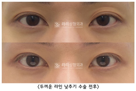 [라리성형외과] 쌍꺼풀수술 그리고 쌍꺼풀재수술 , 성공하려면 어디서 해야 할까요 !? 관련 이미지 5