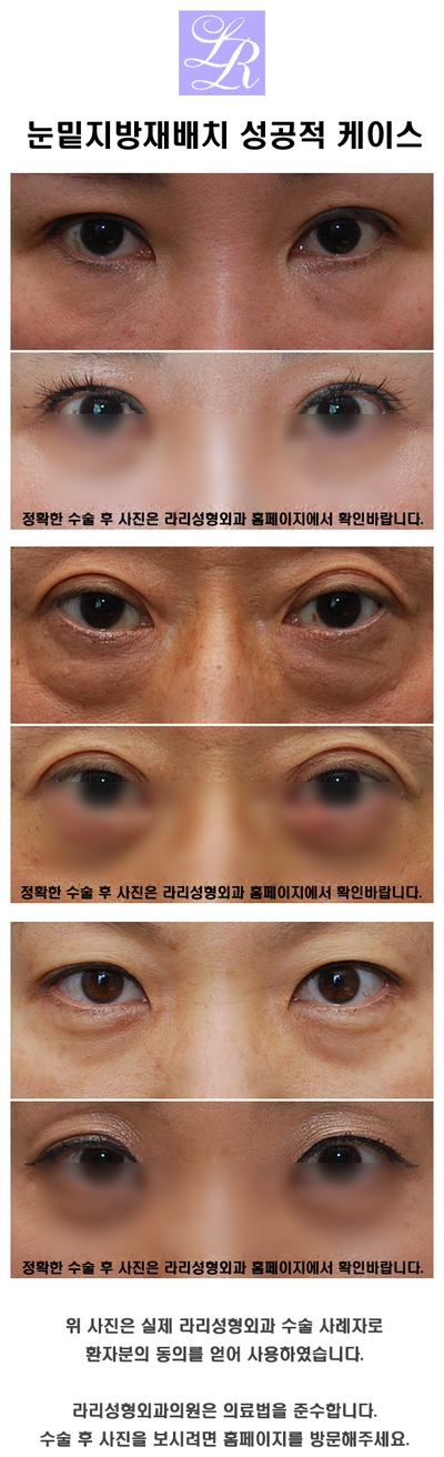 눈밑지방재배치는 눈밑지방제거와 다르다? 관련 이미지 2