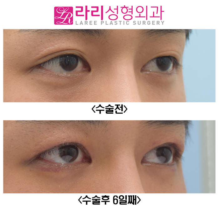 [라리성형외과] 쌍꺼풀없애는수술 전후사진 일주일이면 실밥 제거 관련 이미지 2