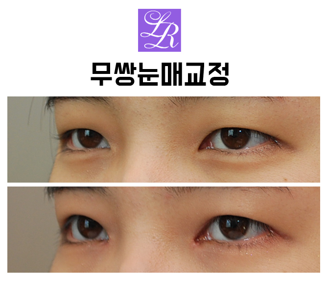 자연스러운 안검하수 교정  -무쌍눈매교정, 비절개눈매교정 관련 이미지 2
