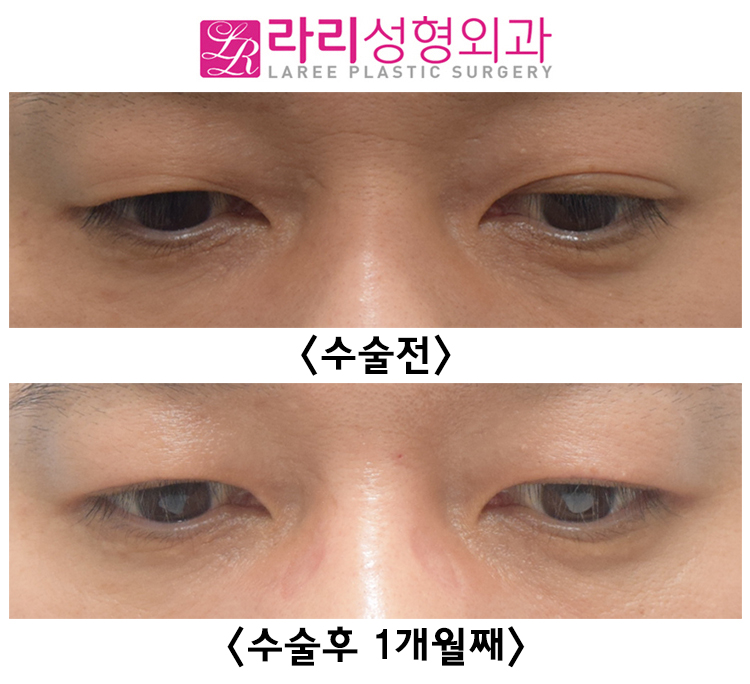 [라리성형외과] 쌍커풀 없애는 수술 후 회복이 빠른 경우 전후 사진 관련 이미지 2